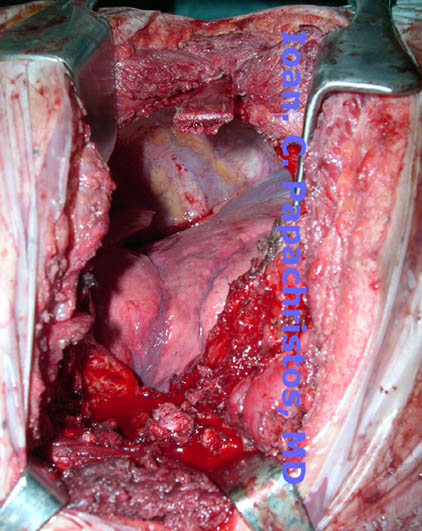 Residual Chest Wall DEFECT post resection of the rib's tumour