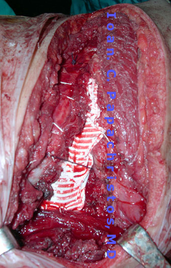 Chest Wall RECONSTRUCTION with a PTFE prosthesis in the manual worker