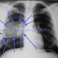 ribaneurysmalcyst4.jpg