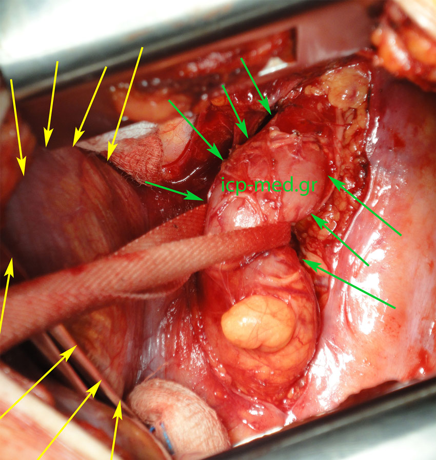 1. A loop passed around the oesophagus (GREEN). YELLOW: left diaphragm