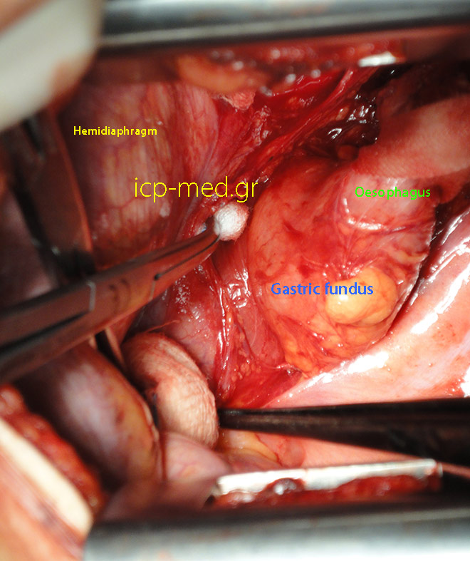 2. The Fundus (GREY/BLUE) is EVIDENTLY inside the left hemithorax = sliding Hiatal Hernia, prior to being repaired