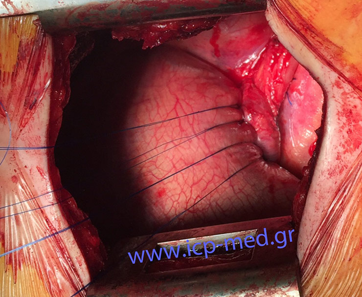 7. Final result in a different case, of a 37-yo non-smoker male.