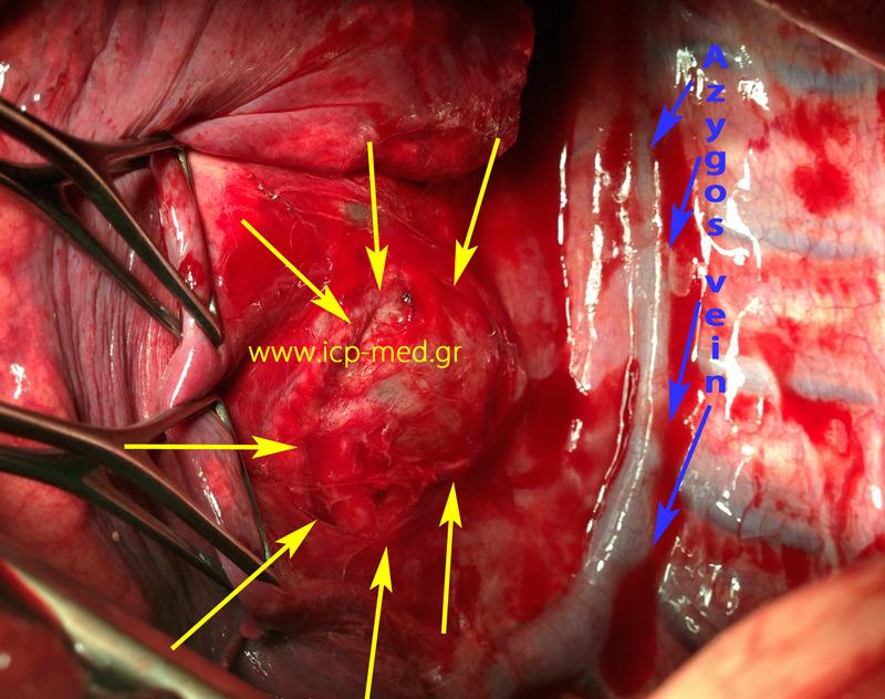 Cyst prior to being dissected. BLUE: Azygos vein