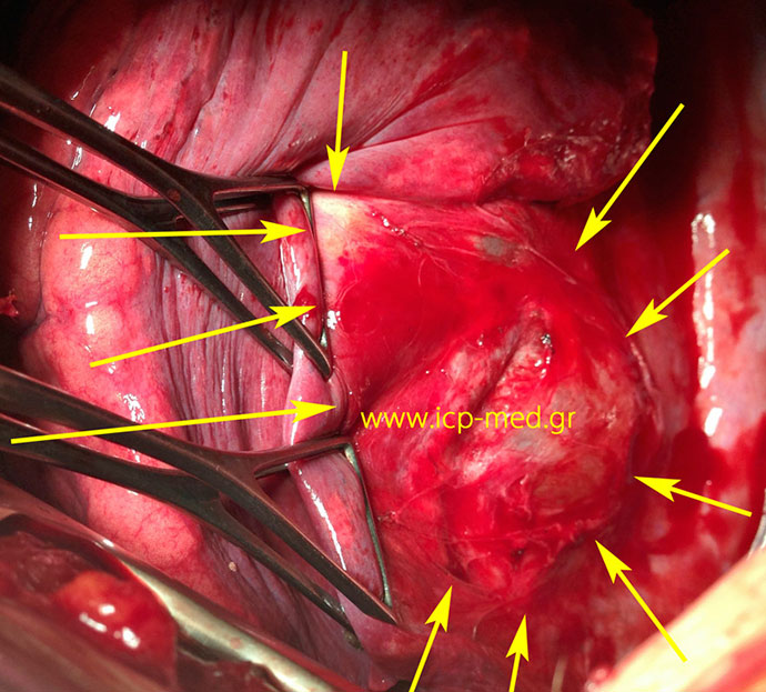 The bronchogenic cyst is being dissected