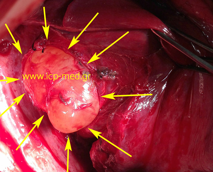 The dissected bronchogenic cyst