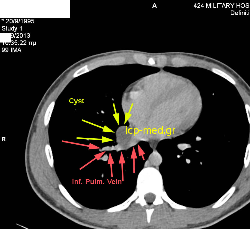 Preop CT: Cyst's close proximity to the inferior Pulm. vein (RED)