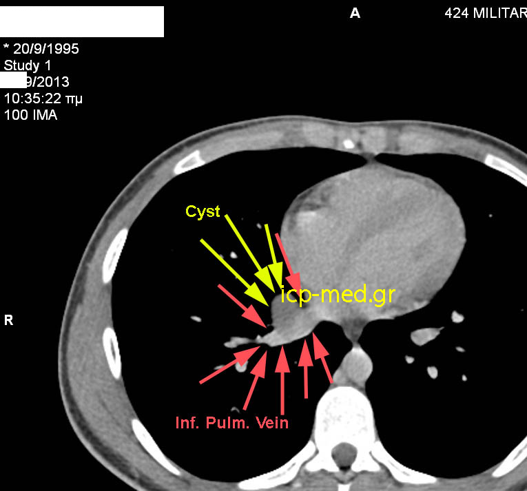 Preop CT: Cyst's close proximity to the inferior Pulm. vein (RED)