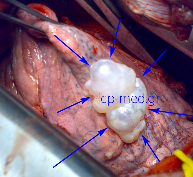 Three confluent bullae