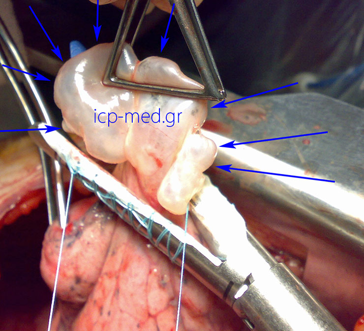 Stapler being positioned for resecting the bullae