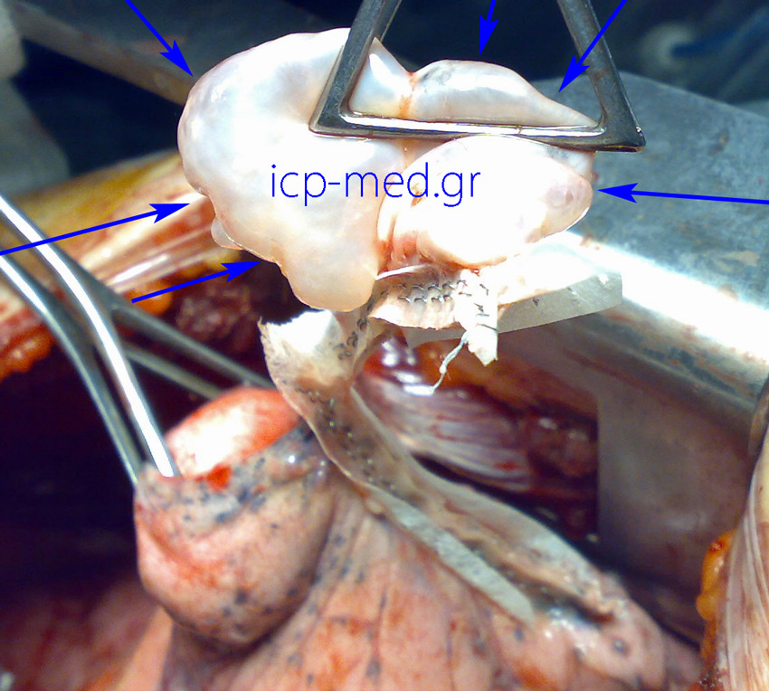 Completion of the resection