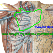 chestwallchondrosarcoma01.jpg