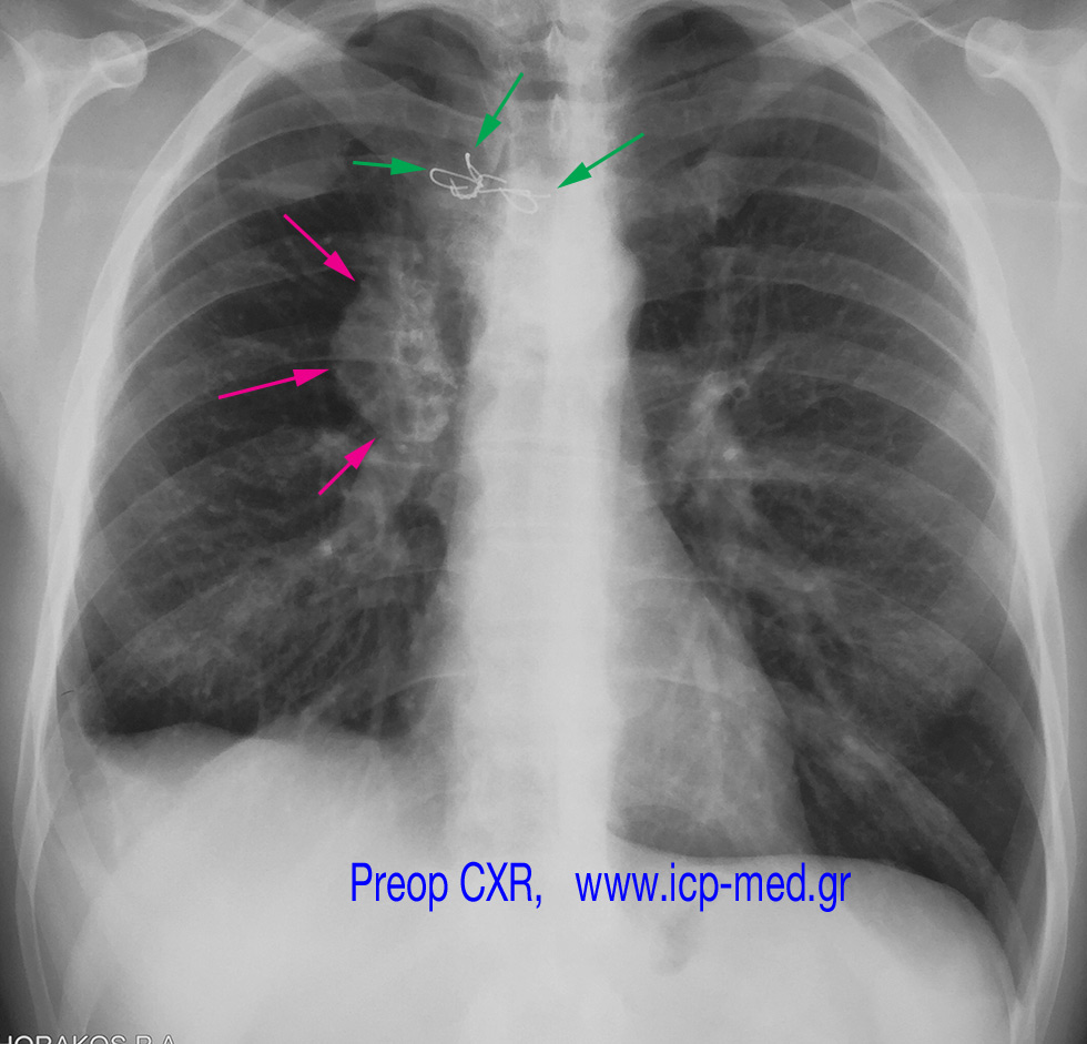 2. PreOp CXR. Magenta arrows: the tumour. Green arrows: steel wire elsewhere 14 yrs before