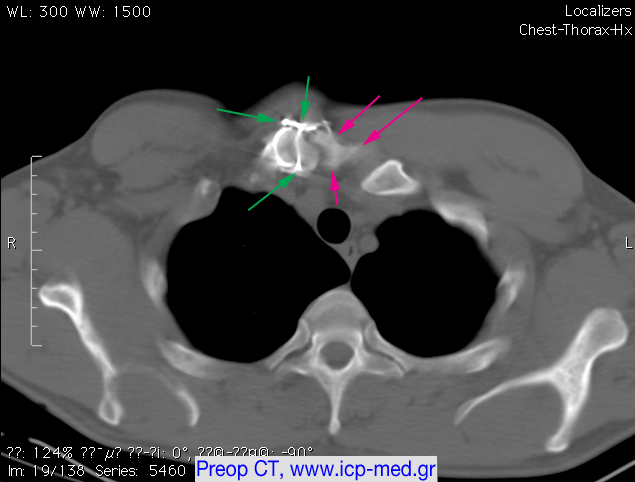 3. PreOp CT. Magenta arrows: the tumour. Green: steel wire elsewhere inserted 14 yrs before