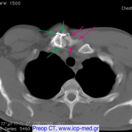 chestwallchondrosarcoma03.jpg