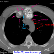 chestwallchondrosarcoma05.jpg