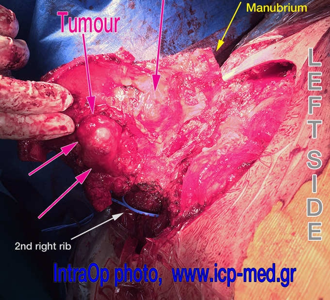 7. IntraOp photo: The left superior ribs were first divided, then the sternum was divided caudal to the right 4th interspace & the left 3rd.