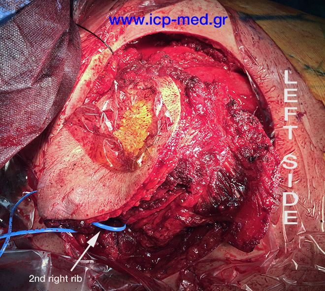 9. IntraOp photo. External view of the specimen, almost completely mobilised along with the overlying musculocutaneous structures