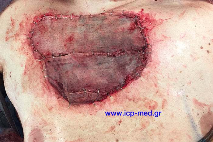 11. IntraOp photo. View of the chest wall after the resectional procedure & the reconstruction