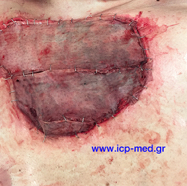 chestwallchondrosarcoma11.jpg