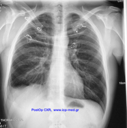 chestwallchondrosarcoma12.jpg