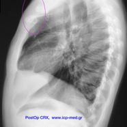 chestwallchondrosarcoma13.jpg