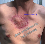 chestwallchondrosarcoma14.jpg