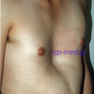 pectusexcavatum01.jpg