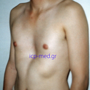 pectusexcavatum02.jpg