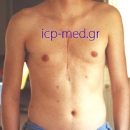 pectusexcavatum03.jpg