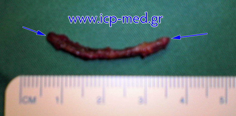 1. The extrapelural foreign body, removed