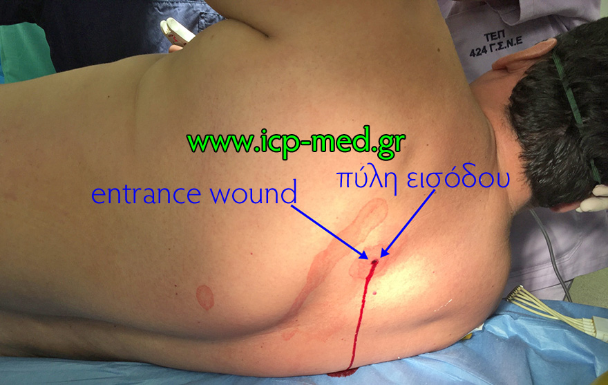 2. The entrance wound, on the left side to the spine, posteriorly, ~4th interspace