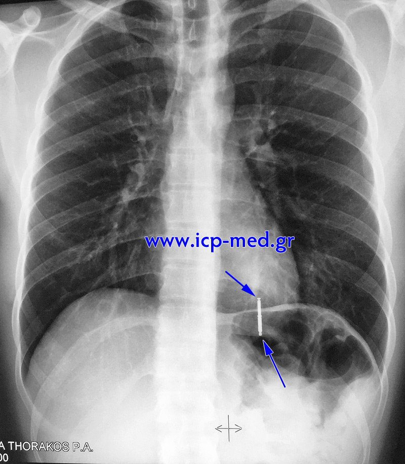 3. Preop CXR (posteroanterior)