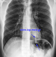 foreignbodlung03.jpg