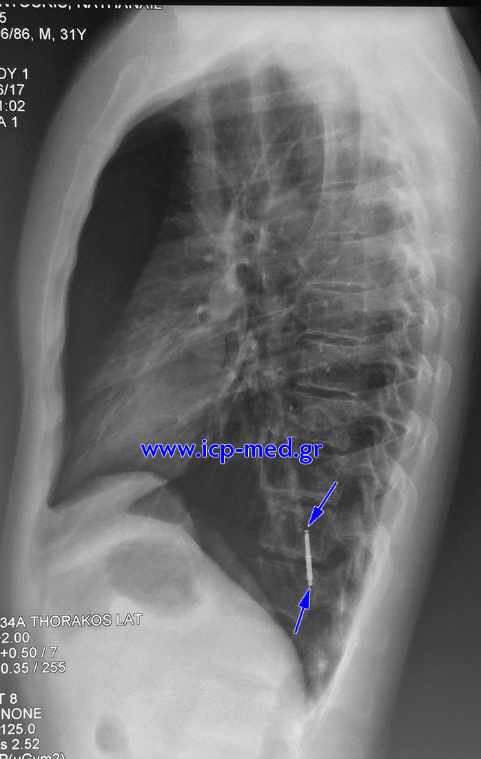 4. Preop CXR (left lateral)