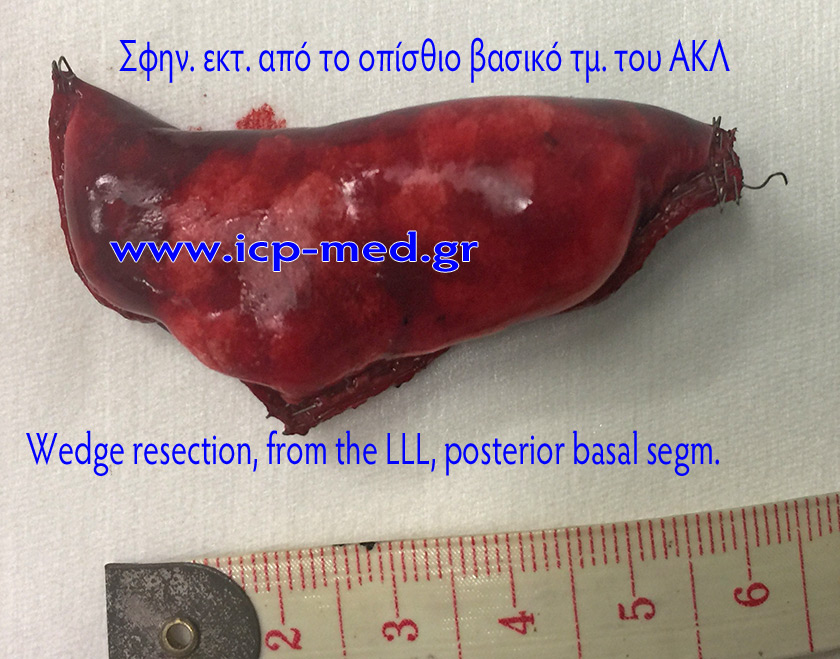 5. Specimen of Wedge Resection from the LLL