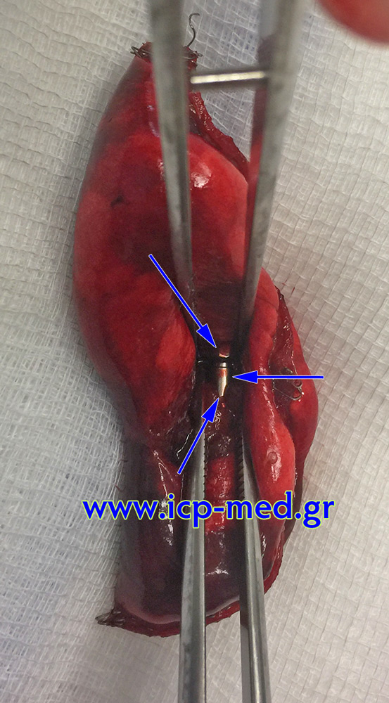 6. In vitro transection of the specimen: foreign body apparent inside