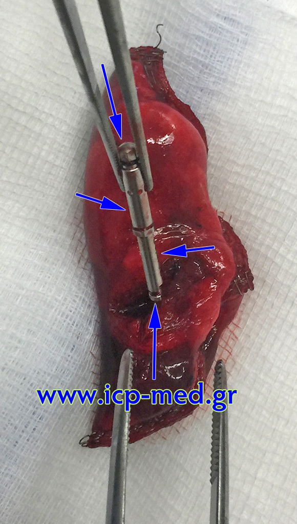 7. Retrieval of the foreign body