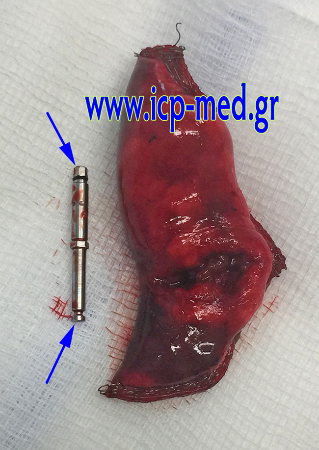 8. Pulmonary specimen and the removed foreign body