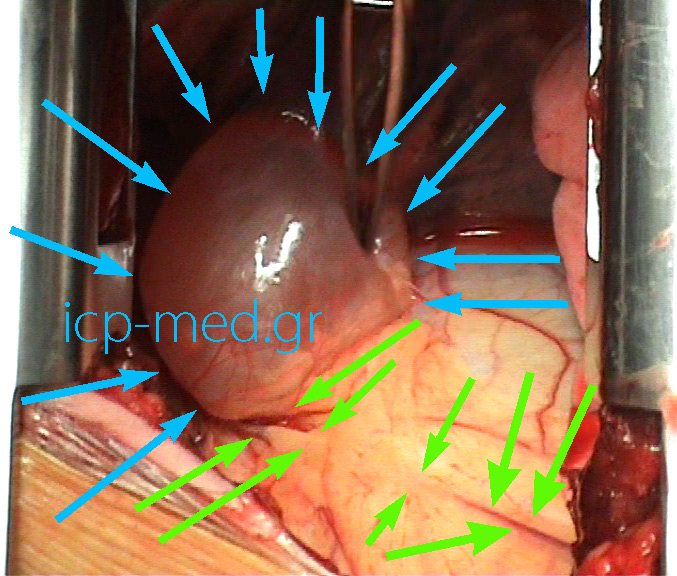 1. Sizeable bulla of the LLL (BLUE). GREEN arrows: the phrenic nerve's course on the pericardium