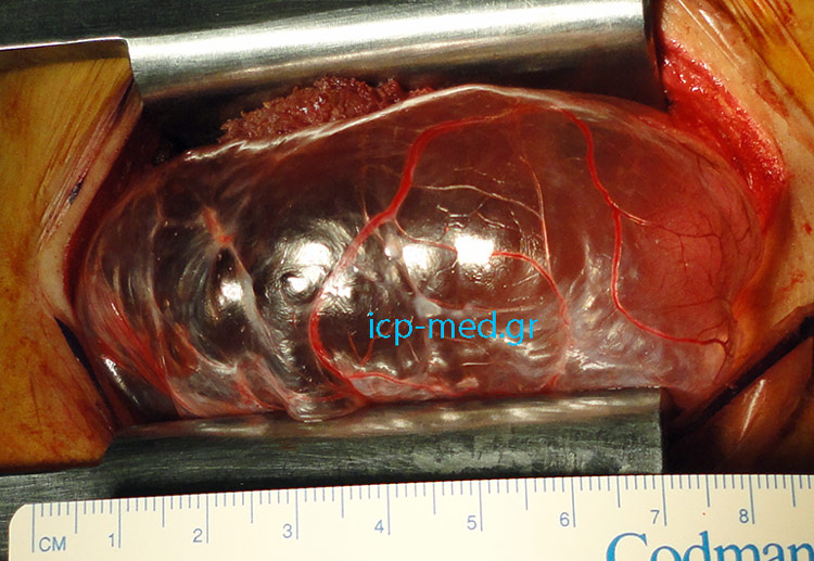 2. Gigantic bulla ( ~8 cm) becomes apparent as soon as a limited thoracotomy (through the bed of the 6th rib) is carried out