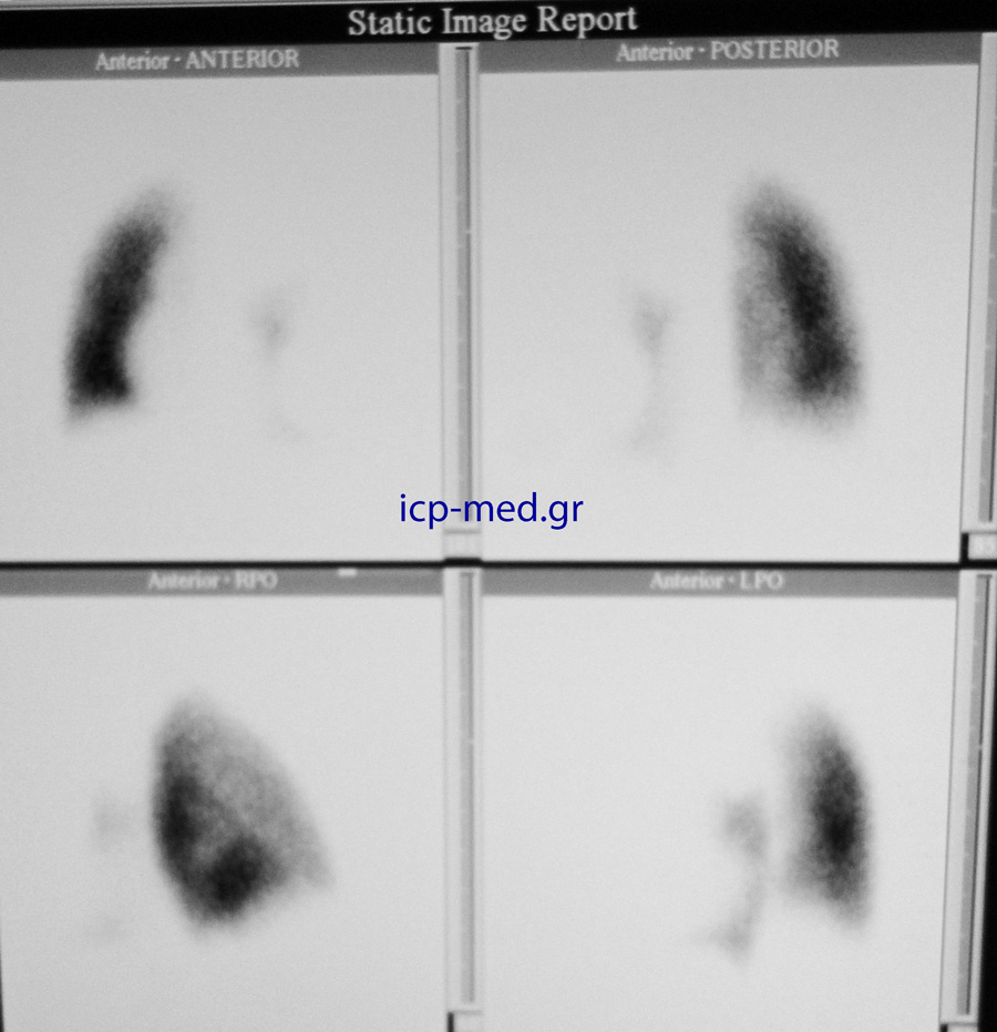 6. Preop radionuclide Scanning demonstrates excessively decreased Perfusion of the left lung