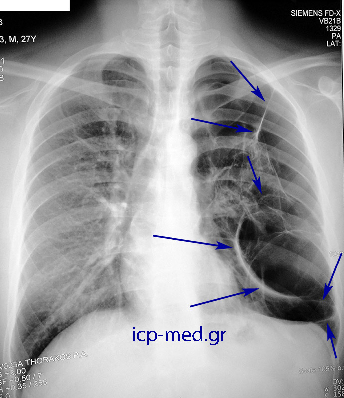 7. Preoperative CXR of the very same case (images 2-11). BLUE: numerous large bullae