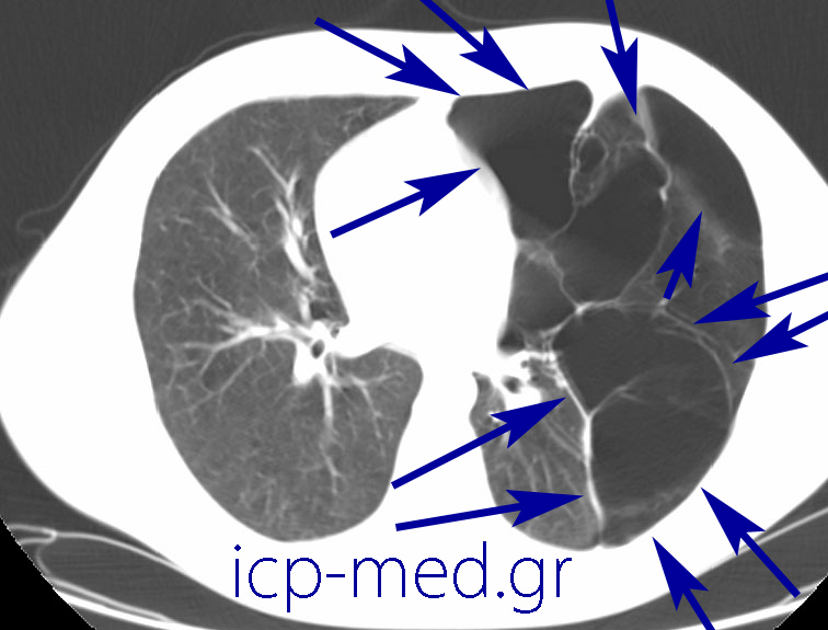 9. Preoperative CT of the very same case (images 2-11). BLUE: numerous large bullae