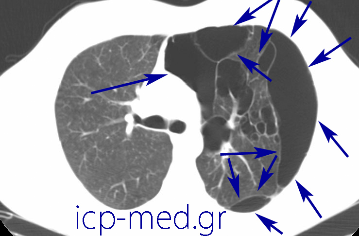 10. Preoperative CT of the very same case (images 2-11). BLUE: numerous large bullae