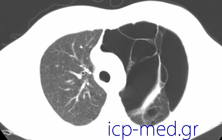 11. Preoperative CT of the very same case (images 2-11). Numerous large bullae