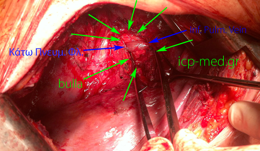 12. The course of the Inferior Pulmonary Vein (BLUE arrows) is apparent through the interior of a Large bulla (GREEN), measuring 7.8 cm