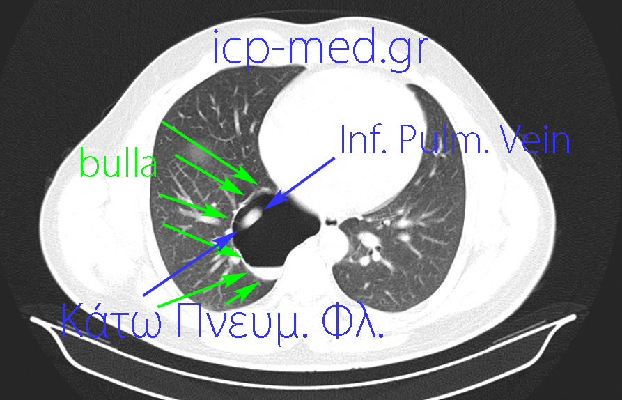 15. Preoperative CT. BLUE arrows: Inferior Pulmonary Vein. GREEN: the bulla