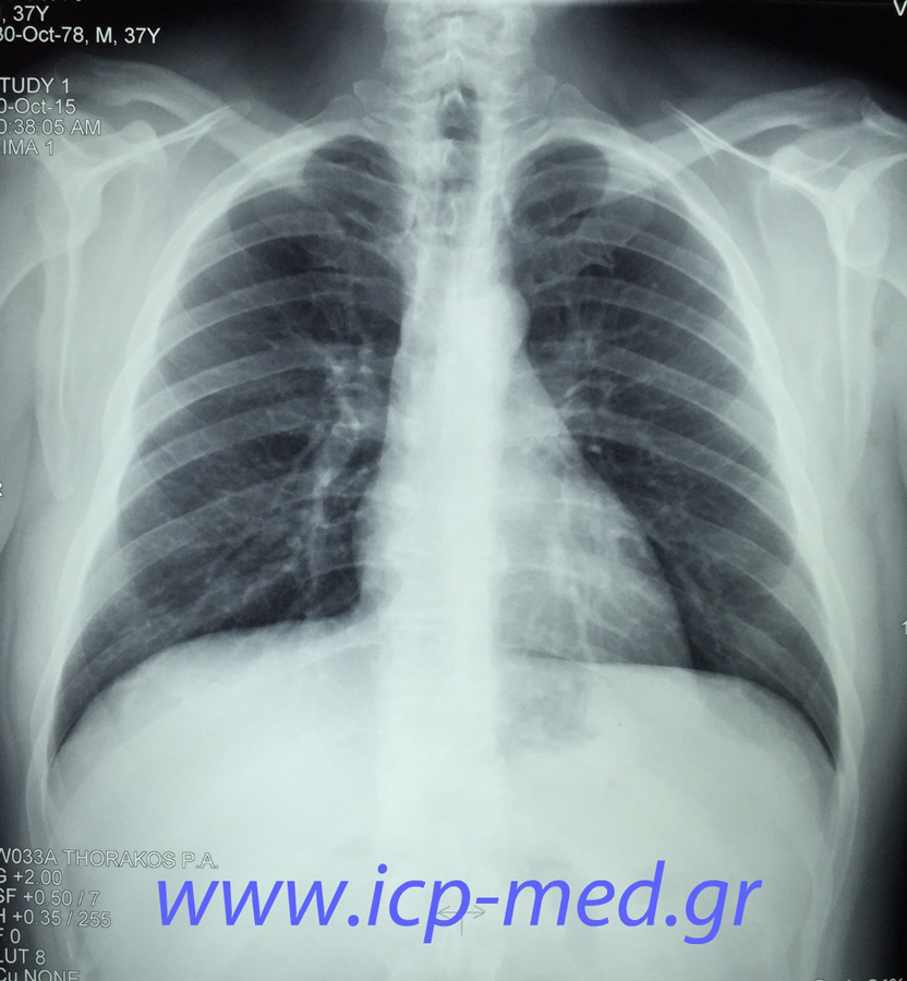 1. Preop plain CXR: look carefully behind the cardiac silhouette!