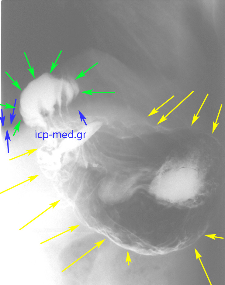 4. Preop Ba swallow: GREEN: hiatal hernia, YELLOW: intraabdominal stomach, BLUE: diaphragm