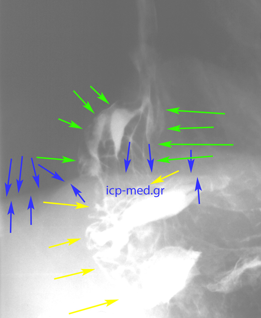 5. Preop Ba swallow: GREEN: hiatal hernia, YELLOW: intraabdominal stomach, BLUE: diaphragm